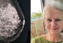 AI Detected Her Early Breast Cancer After Annual Test Came Back as Normal: ‘I feel so lucky’