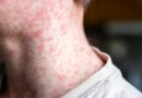 Measles is making a comeback in Canada. What’s driving the surge? – National