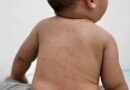 Measles cases show signs of exponential growth in western Canada, say health experts